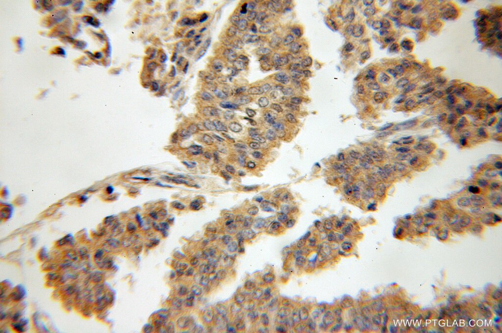 Immunohistochemistry of paraffin-embedded human breast cancer using 51007-1-AP(ABCB6 Antibody) at Dilution 1:50 (under 10x lens) ABCB6 IHC Immunohistochemical 51007-1-AP ABCB6 Antibody ABC; ABC14; EST45597; FLJ22414; MTABC3; PRP; umat