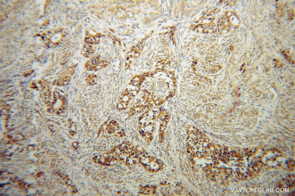 ADAM12 IHC Immunohistochemical 14139-1-AP ADAM12 Antibody MCMP; MCMPMltna; MLTN; MLTNA