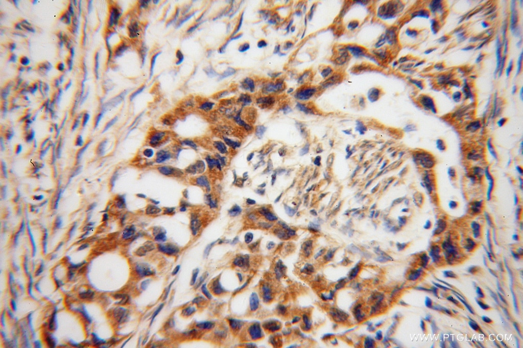 ADAM12 IHC Immunohistochemical 14139-1-AP ADAM12 Antibody MCMP; MCMPMltna; MLTN; MLTNA