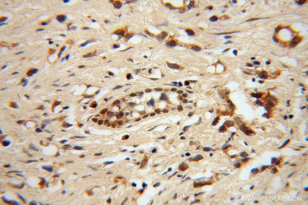ADAR1 IHC Immunohistochemical 14330-1-AP ADAR1 Antibody ADAR1; DRADA; DSH; DSRAD; G1P1; IFI-4; IFI4; K88dsRBP; p136