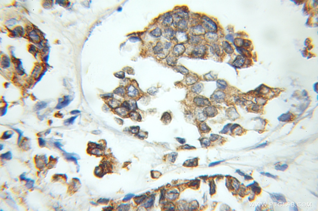 Immunohistochemistry of paraffin-embedded human breast cancer using 11967-1-AP(AGR3 Antibody) at Dilution 1:50 (under 10x lens) AGR3 IHC Immunohistochemical 11967-1-AP AGR3 Antibody AG3; BCMP11; HAG3; PDIA18; hAG-3