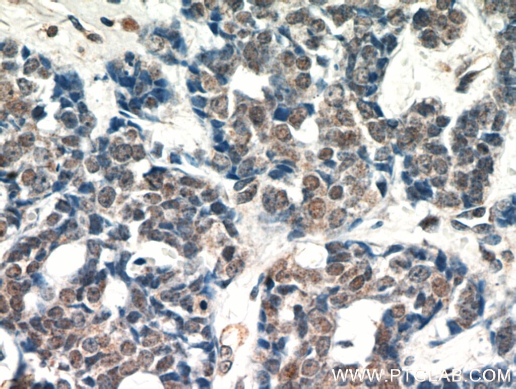 AKT IHC Immunohistochemical 10176-2-AP AKT Antibody AKT; MGC99656; PKB; PKB-ALPHA; PRKBA; RAC; RAC-ALPHA