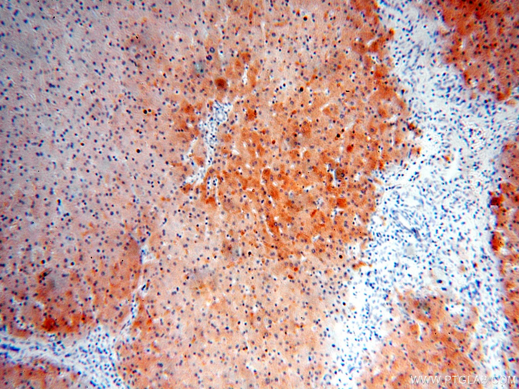 ALDOB IHC Immunohistochemical 18065-1-AP ALDOB Antibody 