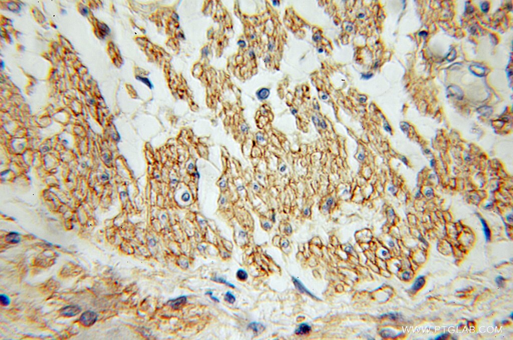 Immunohistochemistry of paraffin-embedded human colon cancer using 12542-1-AP(ANXA6 Antibody) at Dilution 1:100 (under 40x lens) ANXA6 IHC Immunohistochemical 12542-1-AP ANXA6 Antibody ANX6; CBP68