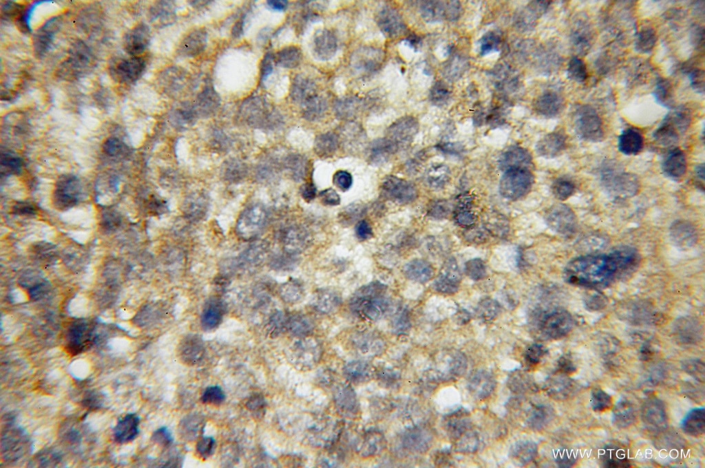 Immunohistochemistry of paraffin-embedded human ovary tumor using 12639-1-AP(APPL1 Antibody) at Dilution 1:50 (under 10x lens) APPL1 IHC Immunohistochemical 12639-1-AP APPL1 Antibody APPL; DIP13alpha