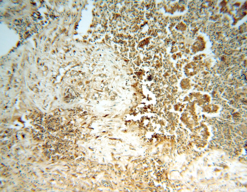 ARF5 IHC Immunohistochemical 15281-1-AP ARF5 Antibody 