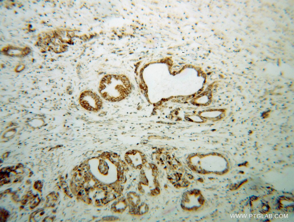 Immunohistochemistry of paraffin-embedded human pancreas cancer using 13490-1-AP(B3GALT4 Antibody) at Dilution 1:100 (under 10x lens) B3GALT4 IHC Immunohistochemical 13490-1-AP B3GALT4 Antibody DJ1033B10.3; Gal-T2; GalT4; beta3GALT4; beta3Gal-T4