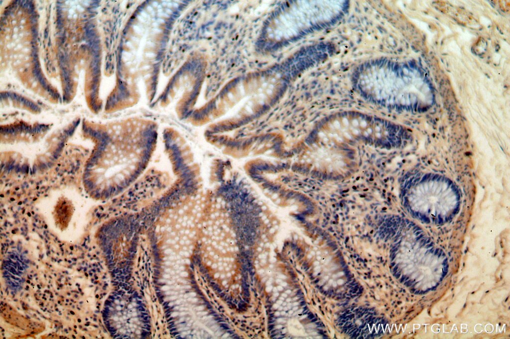 B3GNT3 IHC Immunohistochemical 18098-1-AP B3GNT3 Antibody B3GAL-T8; B3GN-T3; B3GNT-3; HP10328; TMEM3; beta3Gn-T3