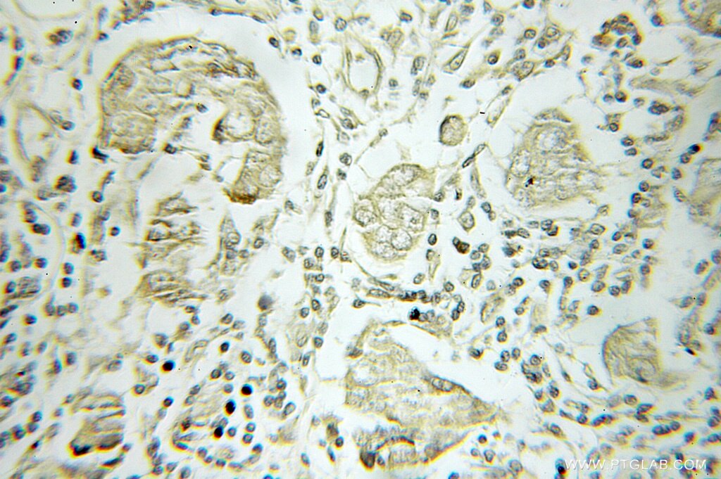 Immunohistochemistry of paraffin-embedded human breast cancer using 11041-1-AP(B4GALT3 Antibody) at Dilution 1:50 (under 10x lens) B4GALT3 IHC Immunohistochemical 11041-1-AP B4GALT3 Antibody beta4Gal-T3