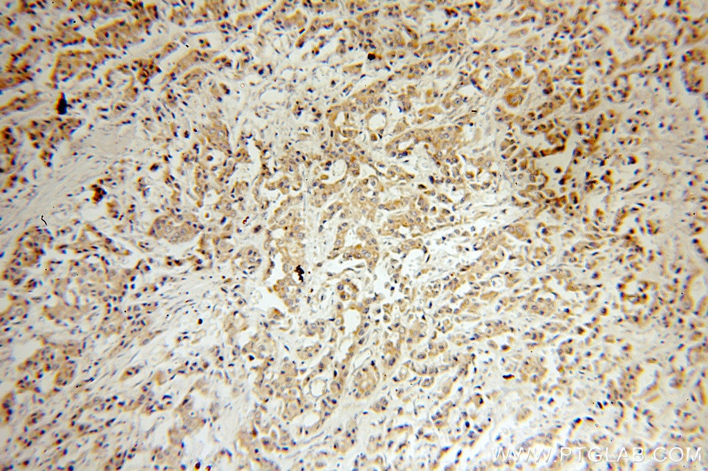 BCL2 IHC Immunohistochemical 12789-1-AP BCL2 Antibody Bcl-2