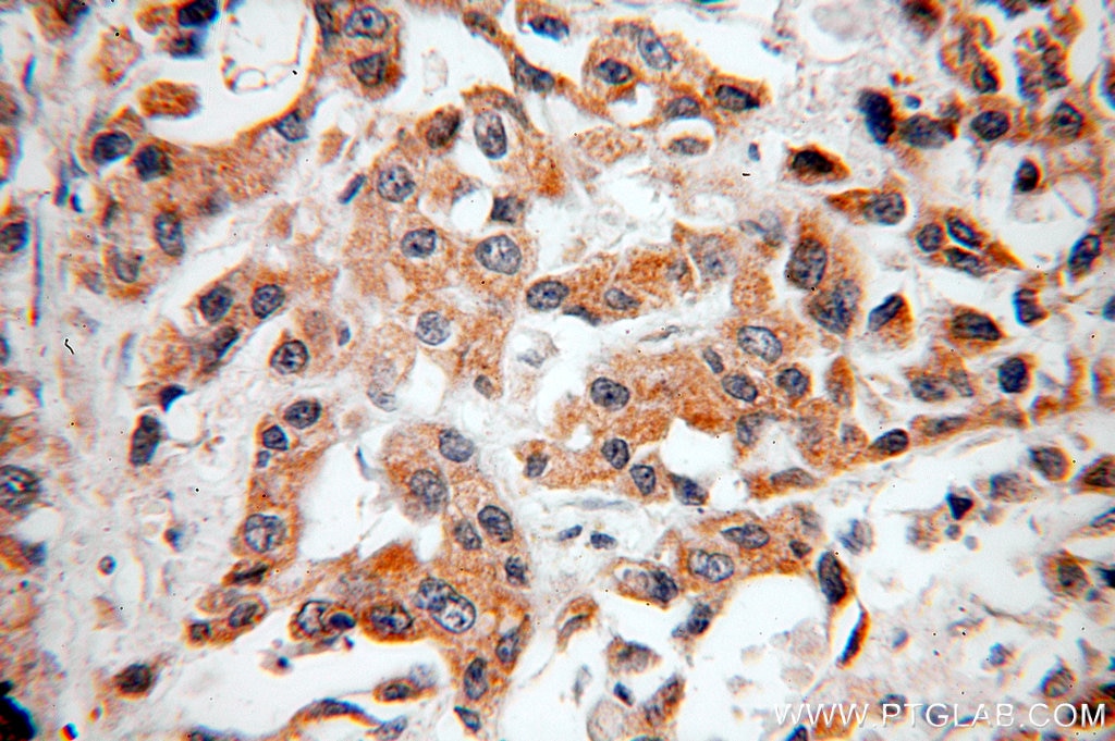 BCL2 IHC Immunohistochemical 12789-1-AP BCL2 Antibody Bcl-2