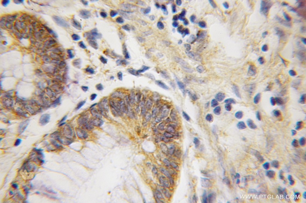Immunohistochemistry of paraffin-embedded human colon cancer using 11294-2-AP(BIRC7 Antibody) at Dilution 1:50 (under 10x lens) BIRC7 IHC Immunohistochemical 11294-2-AP BIRC7 Antibody KIAP; LIVIN; ML-IAP; MLIAP; RNF50