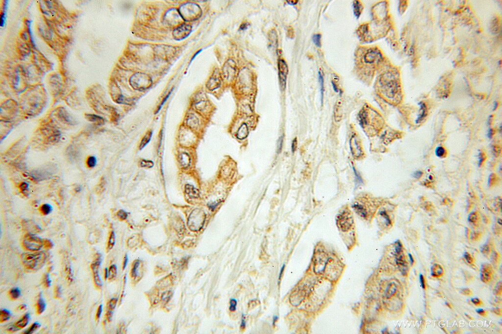 Immunohistochemistry of paraffin-embedded human pancreas cancer using 10510-1-AP(BLK Antibody) at Dilution 1:10 (under 10x lens) BLK IHC Immunohistochemical 10510-1-AP BLK Antibody MGC10442