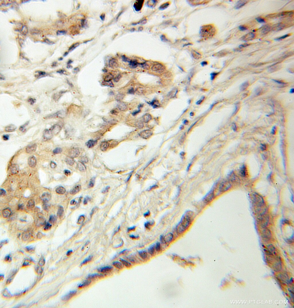 Immunohistochemistry of paraffin-embedded human pancreas cancer using 10855-1-AP(BLNK Antibody) at Dilution 1:100 (under 10x lens) BLNK IHC Immunohistochemical 10855-1-AP BLNK Antibody BASH; BLNK-S; LY57; MGC111051; SLP-65; SLP65