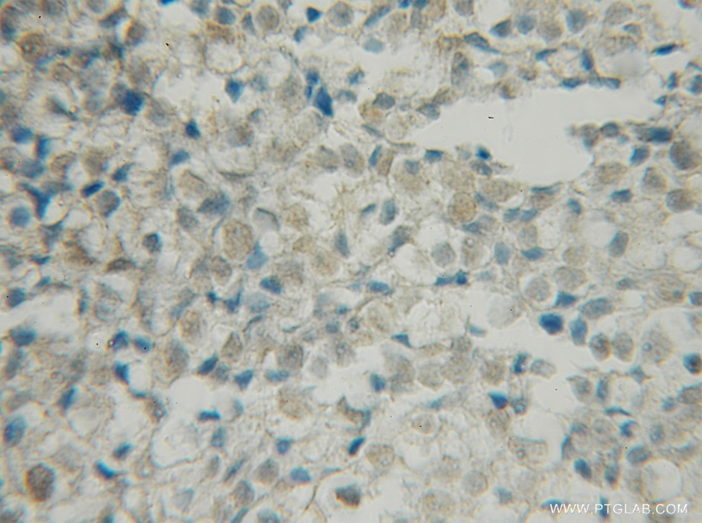 Immunohistochemistry of paraffin-embedded human ovary tumor using 12673-1-AP(BRSK1 Antibody) at Dilution 1:50 (under 10x lens) BRSK1 IHC Immunohistochemical 12673-1-AP BRSK1 Antibody FLJ43009; KIAA1811