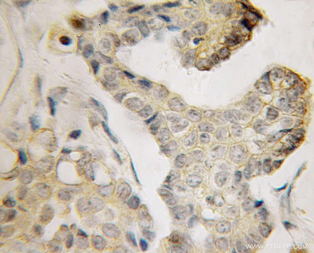 Immunohistochemistry of paraffin-embedded human ovary tumor using 12920-1-AP(BVES Antibody) at Dilution 1:100 (under 10x lens) BVES IHC Immunohistochemical 12920-1-AP BVES Antibody HBVES; MGC42413; POP1; POPDC1