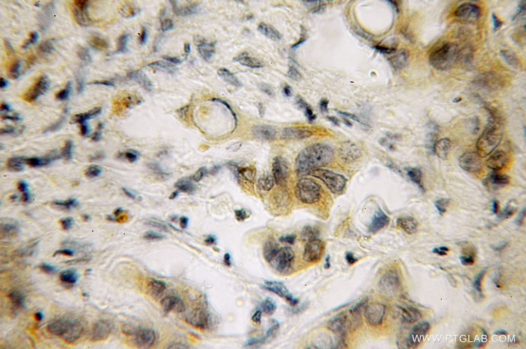 Bcl-xL IHC Immunohistochemical 10783-1-AP Bcl-xL Antibody BCL-XL/S; BCL2L; BCLX; Bcl-X; DKFZp781P2092; bcl-xL; bcl-xS
