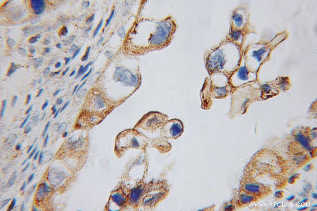 Immunohistochemistry of paraffin-embedded human ovary tumor using 10292-1-AP(calreticulin Antibody) at Dilution 1:50 (under 10x lens) calreticulin IHC Immunohistochemical 10292-1-AP calreticulin Antibody CRT; FLJ26680; RO; SSA; cC1qR