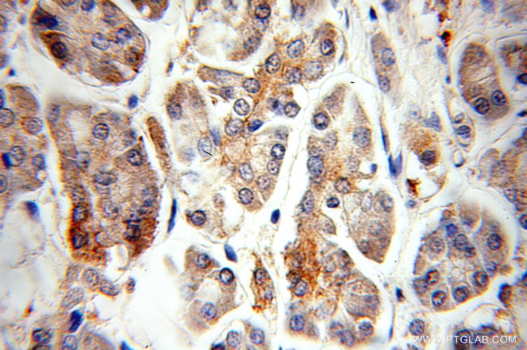 Immunohistochemistry of paraffin-embedded human pancreas cancer using 10944-1-AP(CRH Antibody) at Dilution 1:50 (under 10x lens) CRH IHC Immunohistochemical 10944-1-AP CRH Antibody CRF