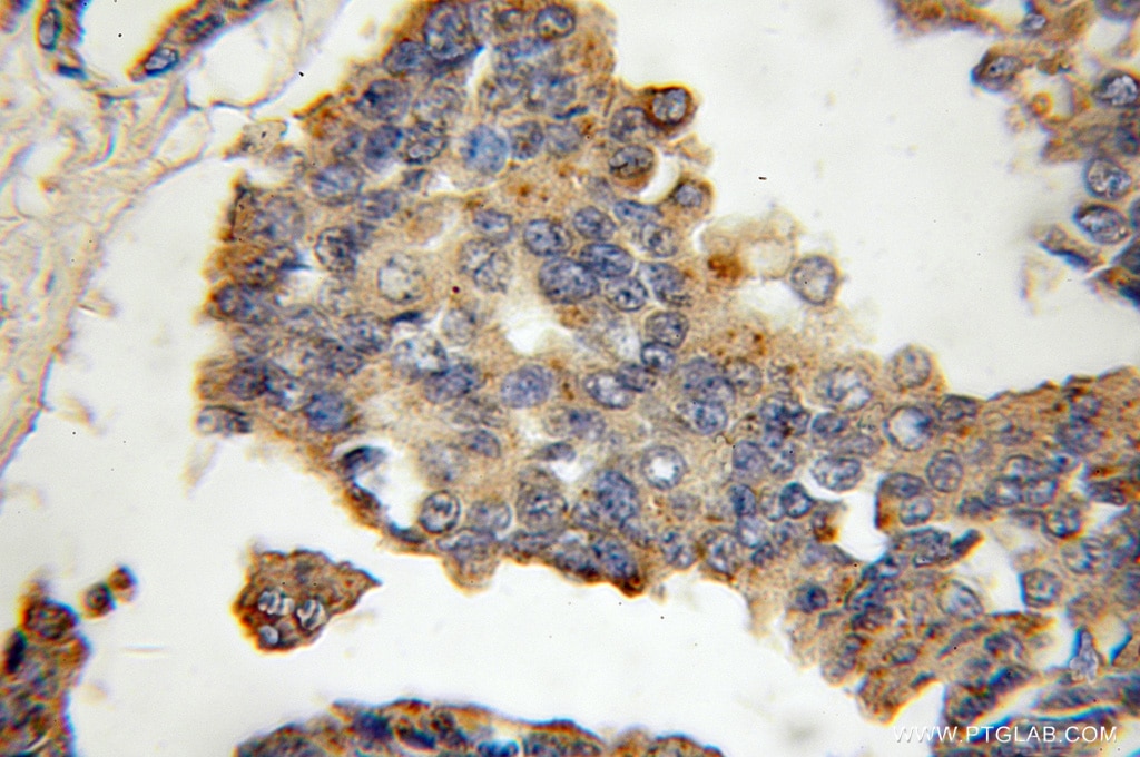 Immunohistochemistry of paraffin-embedded human breast cancer using 11239-1-AP(CTSK Antibody) at Dilution 1:100 (under 10x lens) CTSK IHC Immunohistochemical 11239-1-AP CTSK Antibody CTS02; CTSO; CTSO1; CTSO2; MGC23107; PKND; PYCD