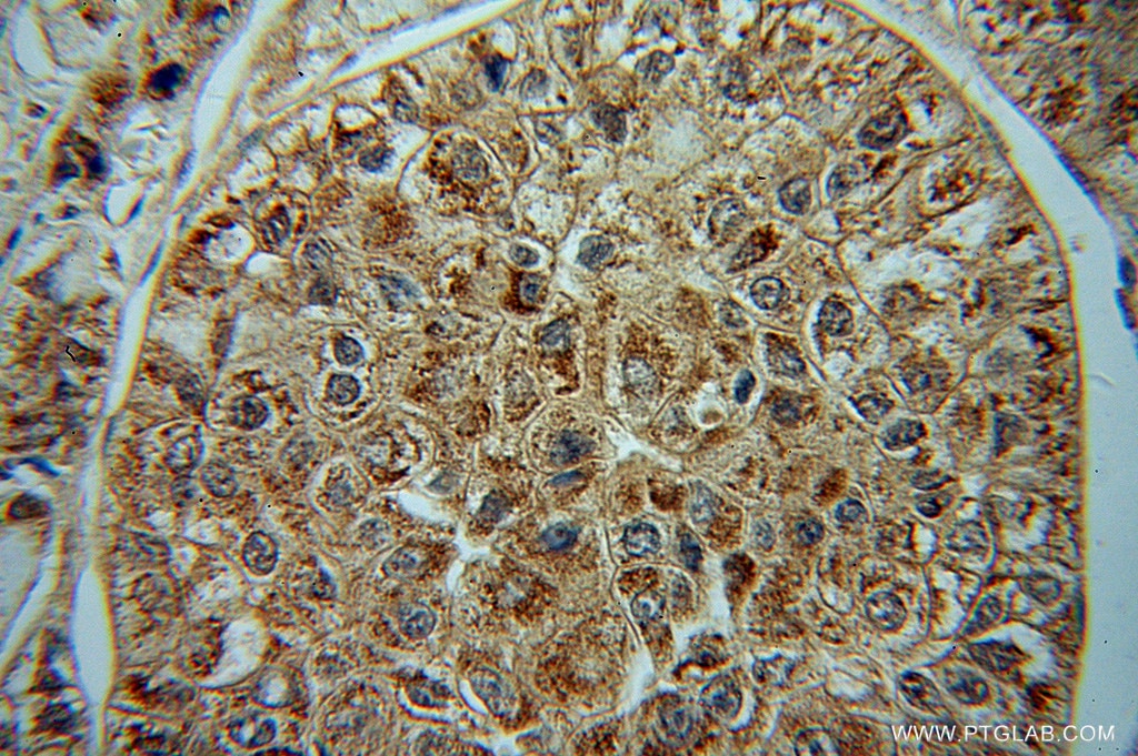 D2HGDH IHC Immunohistochemical 13895-1-AP D2HGDH Antibody D2HGD; FLJ42195; MGC25181