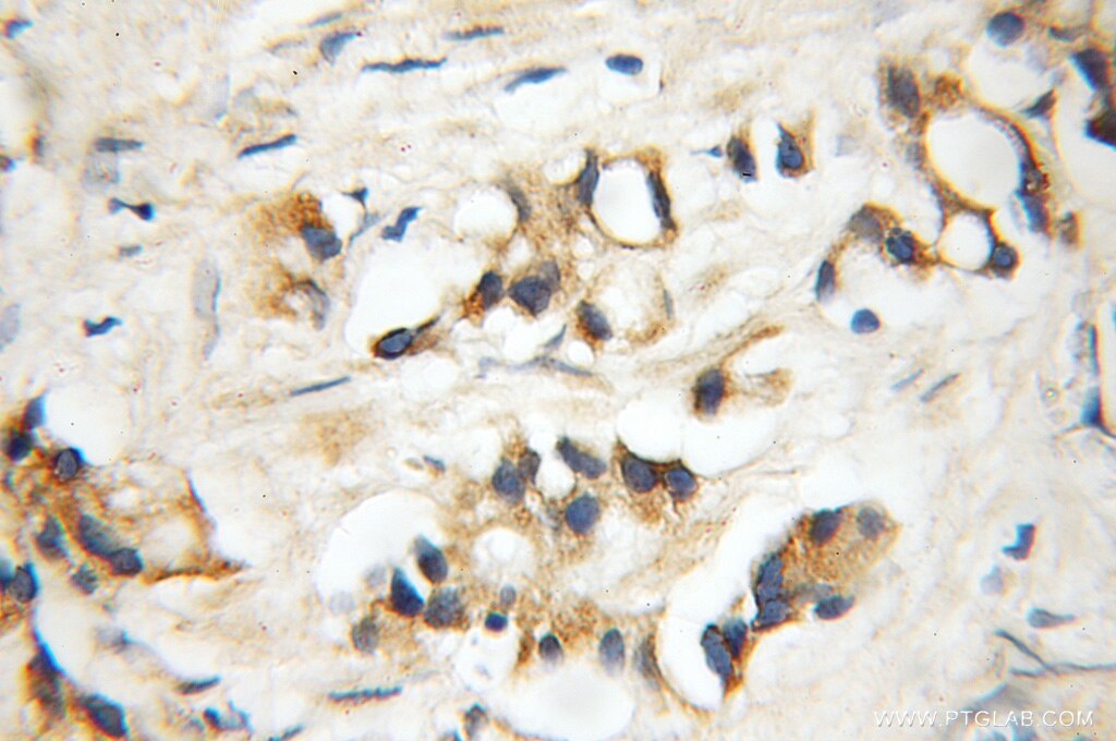 Immunohistochemistry of paraffin-embedded human prostate cancer using 11617-1-AP(DDX28 Antibody) at Dilution 1:50 (under 10x lens) DDX28 IHC Immunohistochemical 11617-1-AP DDX28 Antibody FLJ11282; MDDX28