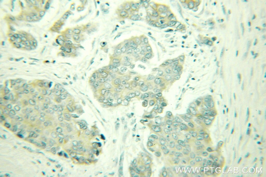 Immunohistochemistry of paraffin-embedded human breast cancer using 10471-1-AP(DHCR24 Antibody) at Dilution 1:100 (under 25x lens) DHCR24 IHC Immunohistochemical 10471-1-AP DHCR24 Antibody KIAA0018; Nbla03646; SELADIN1; seladin-1