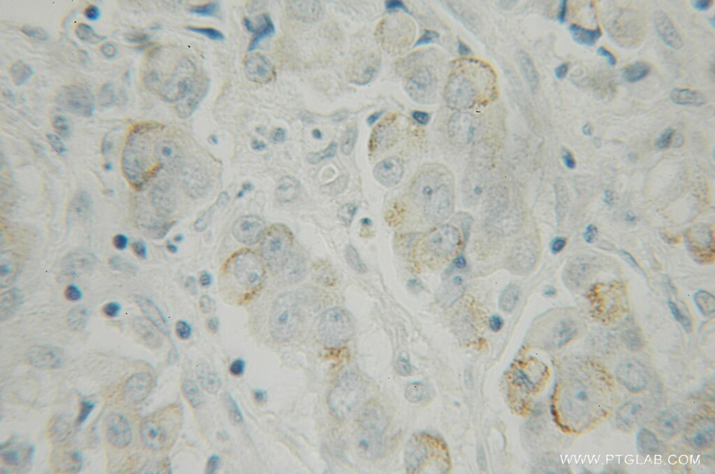 Immunohistochemistry of paraffin-embedded human prostate cancer using 12752-1-AP(DPP8 Antibody) at Dilution 1:100 (under 10x lens) DPP8 IHC Immunohistochemical 12752-1-AP DPP8 Antibody DP8; DPRP1; FLJ14920; FLJ20283; MGC26191; MSTP141