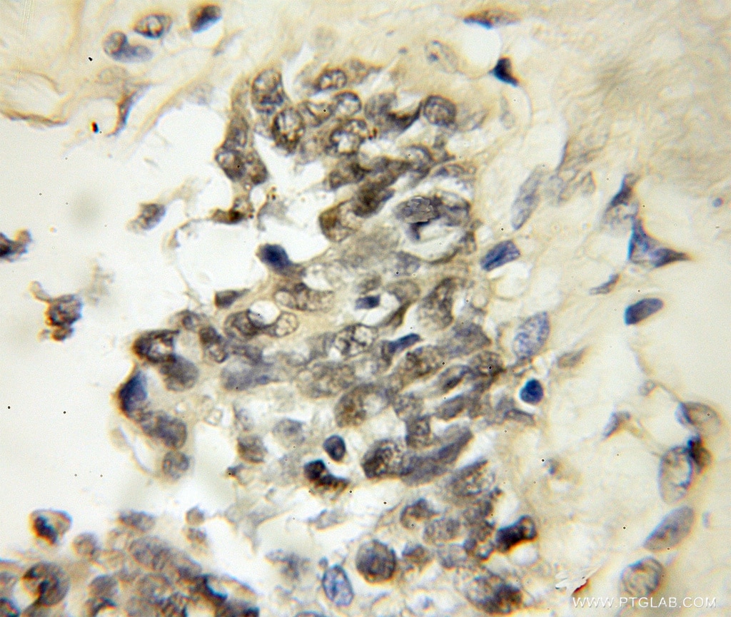 Immunohistochemistry of paraffin-embedded human breast cancer using 12171-1-AP(E2F1 Antibody) at Dilution 1:50 (under 10x lens) E2F1 IHC Immunohistochemical 12171-1-AP E2F1 Antibody E2F-1; RBAP1; RBBP3; RBP3