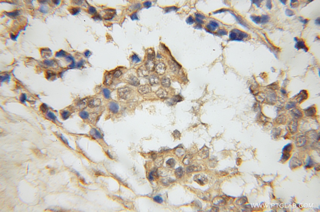 Immunohistochemistry of paraffin-embedded human breast cancer using 12255-1-AP(EBAG9 Antibody) at Dilution 1:50 (under 10x lens) EBAG9 IHC Immunohistochemical 12255-1-AP EBAG9 Antibody EB9; PDAF; RCAS1