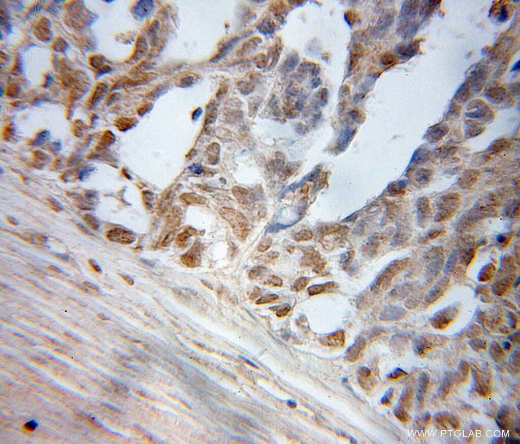 Immunohistochemistry of paraffin-embedded human ovary tumor using 51044-1-AP(ELL Antibody) at Dilution 1:50 (under 10x lens) ELL IHC Immunohistochemical 51044-1-AP ELL Antibody C19orf17; DKFZp434I1916; ELL1; MEN