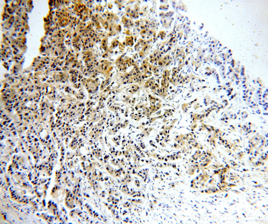 EPCAM IHC Immunohistochemical 21050-1-AP EPCAM Antibody CO-17A; CO17-1A; EGP; EGP-2; EGP34; EGP40; ESA; Ep-CAM; GA733-2; KS1/4; KSA; M4S1; MIC18; MK-1; TACST-1; TACSTD1; TROP1; hEGP-2