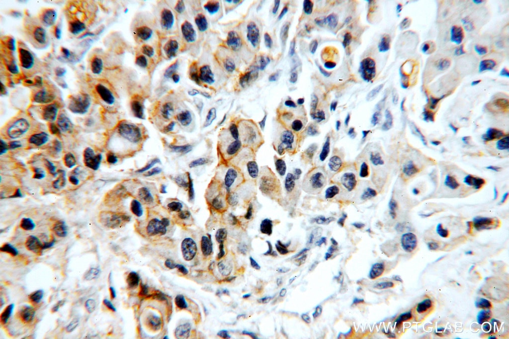 EPCAM IHC Immunohistochemical 21050-1-AP EPCAM Antibody CO-17A; CO17-1A; EGP; EGP-2; EGP34; EGP40; ESA; Ep-CAM; GA733-2; KS1/4; KSA; M4S1; MIC18; MK-1; TACST-1; TACSTD1; TROP1; hEGP-2