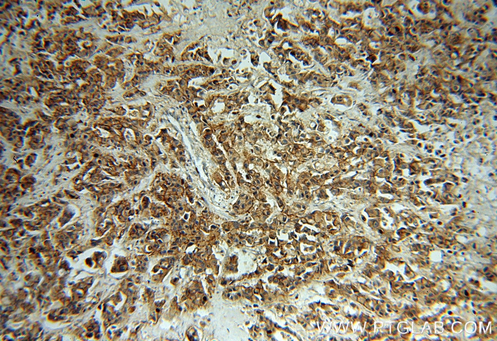 ERBB2 IHC Immunohistochemical 51105-1-AP ERBB2 Antibody CD340; HER-2; HER-2/neu; HER2; NEU; NGL; TKR1