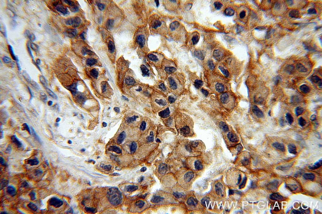 ERBB2 IHC Immunohistochemical 51105-1-AP ERBB2 Antibody CD340; HER-2; HER-2/neu; HER2; NEU; NGL; TKR1