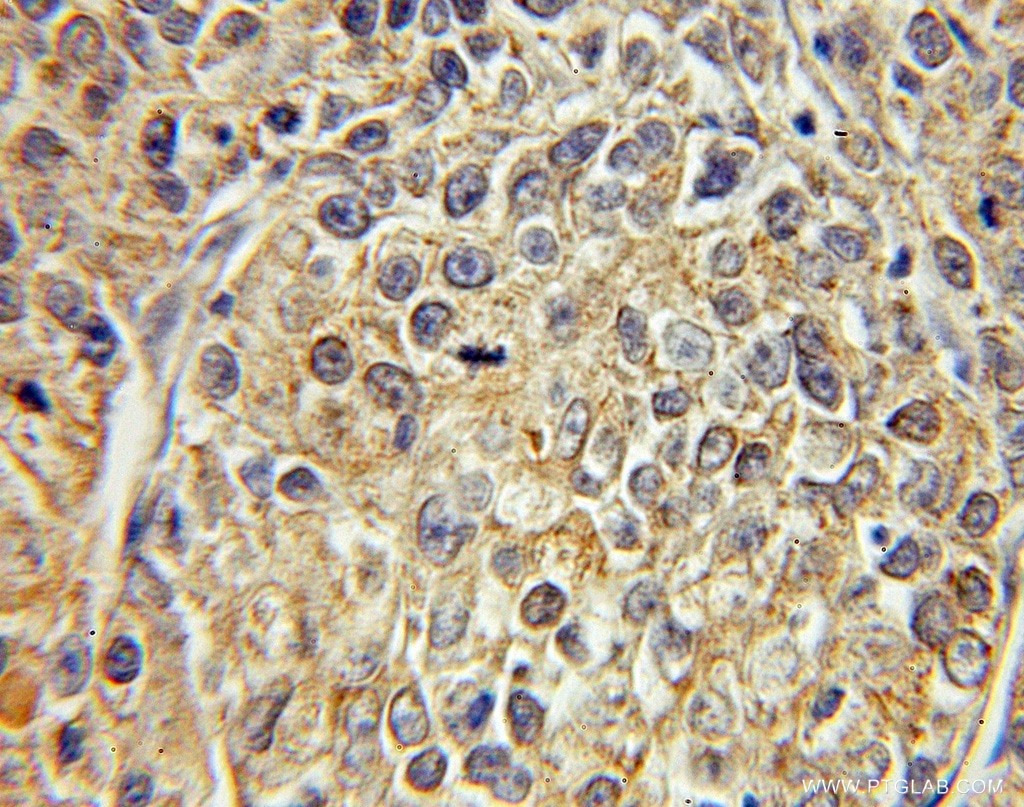 Immunohistochemistry of paraffin-embedded human lung cancer using 12348-1-AP(FABP5 Antibody) at Dilution 1:50 (under 10x lens) FABP5 IHC Immunohistochemical 12348-1-AP FABP5 Antibody E-FABP; EFABP; PA-FABP; PAFABP