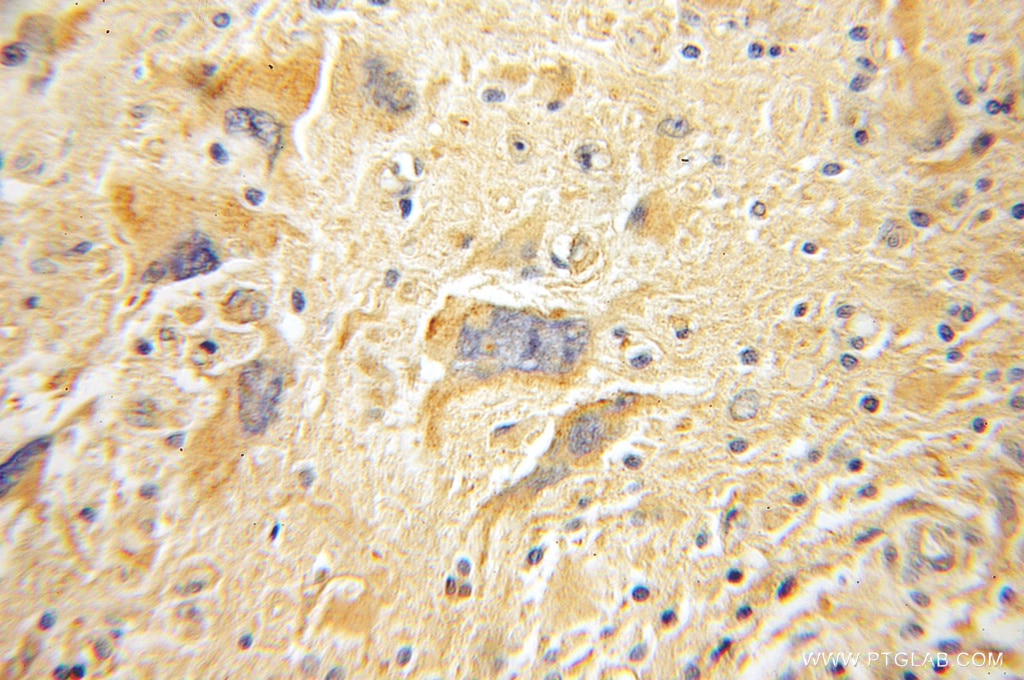 Immunohistochemistry of paraffin-embedded Gliomas using 12636-1-AP(FAK Antibody) at Dilution 1:100 (under 10x lens) FAK IHC Immunohistochemical 12636-1-AP FAK Antibody PTK2;FADK;FAK;FAK1;pp125FAK ;