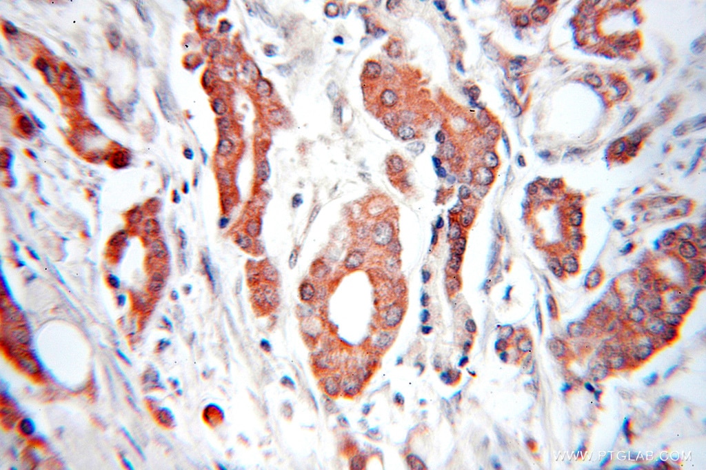 Immunohistochemistry of paraffin-embedded human prostate cancer using 11161-1-AP(FBXO9 Antibody) at Dilution 1:50 (under 10x lens) FBXO9 IHC Immunohistochemical 11161-1-AP FBXO9 Antibody DKFZp434C0118; FBX9; KIAA0936; NY-REN-57; VCIA1; dJ341E18.2