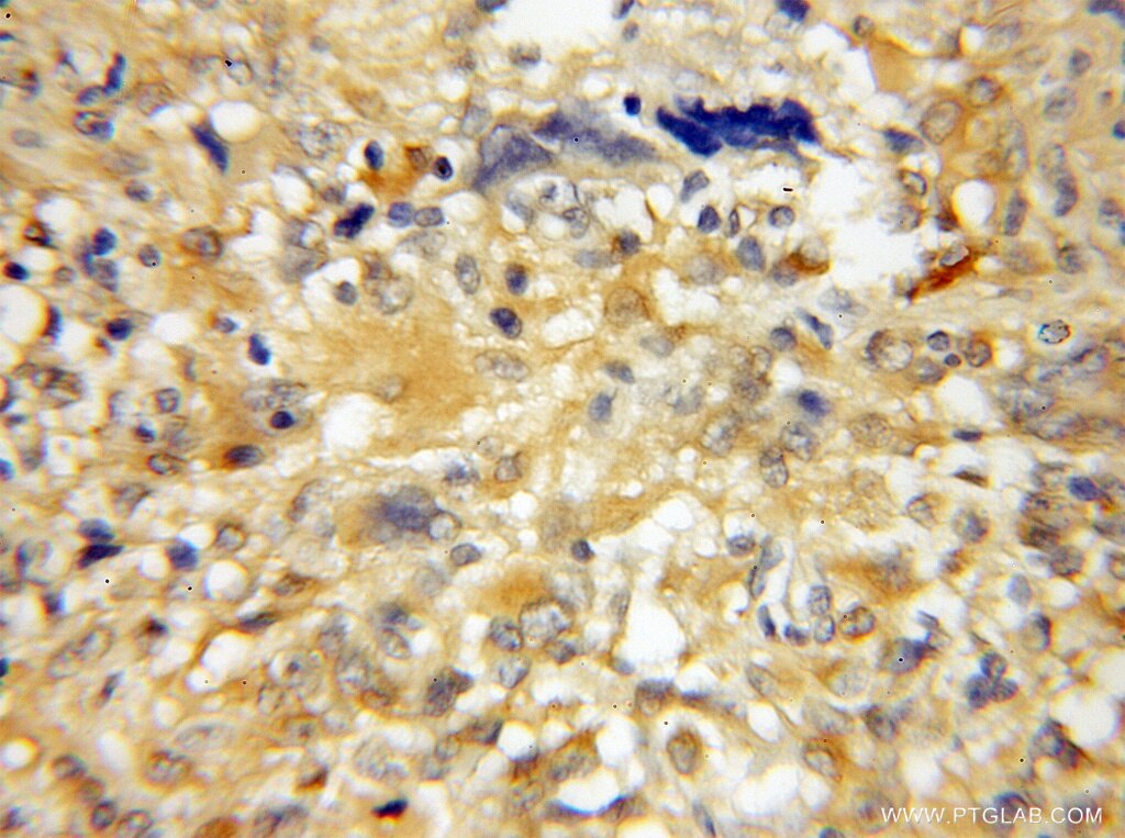 Immunohistochemistry of paraffin-embedded human gliomas using 12100-1-AP(FEZ1 Antibody) at Dilution 1:50 (under 10x lens) FEZ1 IHC Immunohistochemical 12100-1-AP FEZ1 Antibody