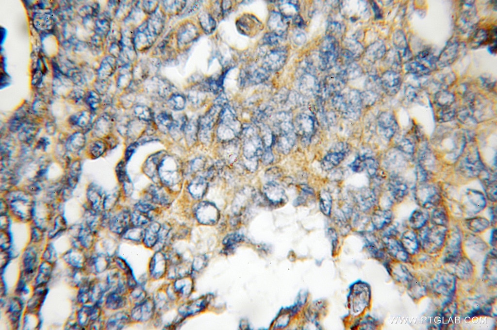 Immunohistochemistry of paraffin-embedded human ovary tumor using 10991-1-AP(FHL1 Antibody) at Dilution 1:100 (under 10x lens) FHL1 IHC Immunohistochemical 10991-1-AP FHL1 Antibody FHL1B; FLH1A; KYO-T; MGC111107; SLIM1; XMPMA; bA535K18.1