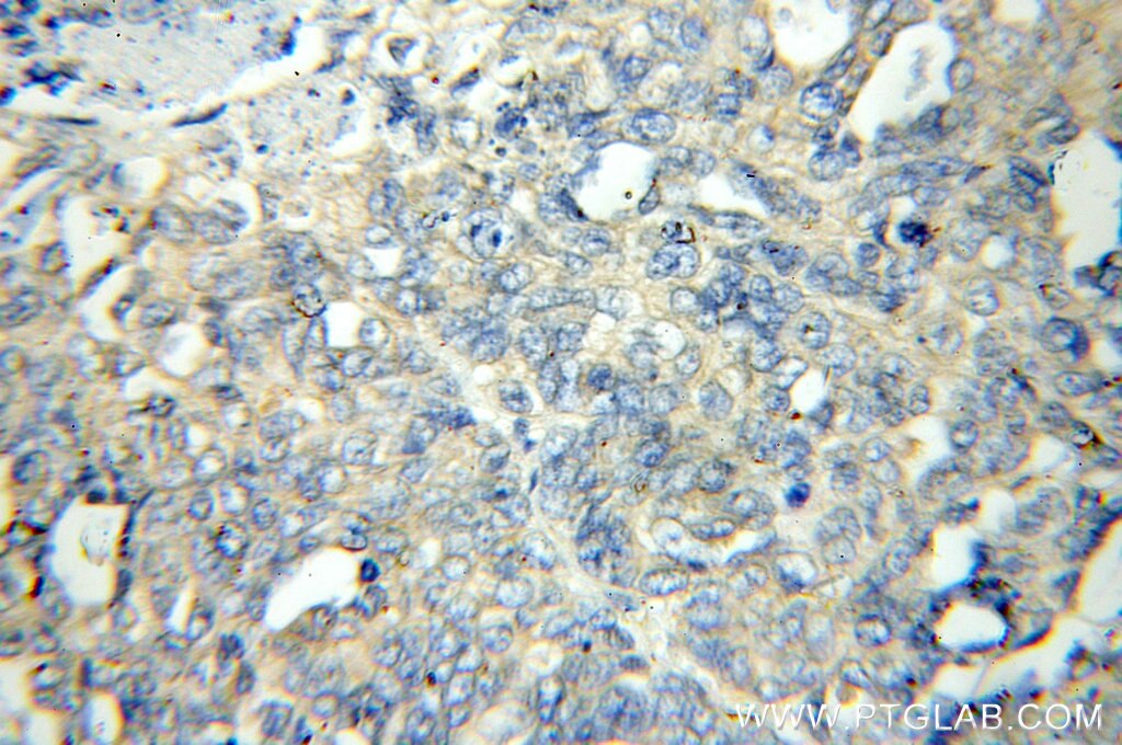 Immunohistochemistry of paraffin-embedded Ovary cancer using 11236-2-AP(FLCN Antibody) at Dilution 1:50 (under 40x lens) FLCN IHC Immunohistochemical 11236-2-AP FLCN Antibody FLCN;BHD;DKFZp547A118;FLCL;FLJ45004;FLJ99377;MGC17998;MGC23445 ;