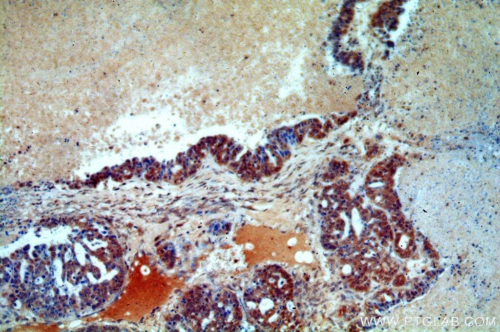 FUS IHC Immunohistochemical 11570-1-AP FUS Antibody CHOP; FUS-CHOP; FUS1; TLS; TLS/CHOP; hnRNP-P2