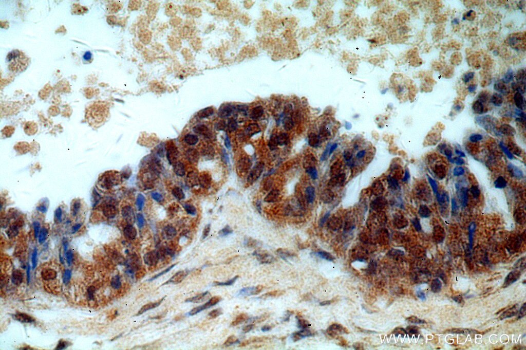 FUS IHC Immunohistochemical 11570-1-AP FUS Antibody CHOP; FUS-CHOP; FUS1; TLS; TLS/CHOP; hnRNP-P2