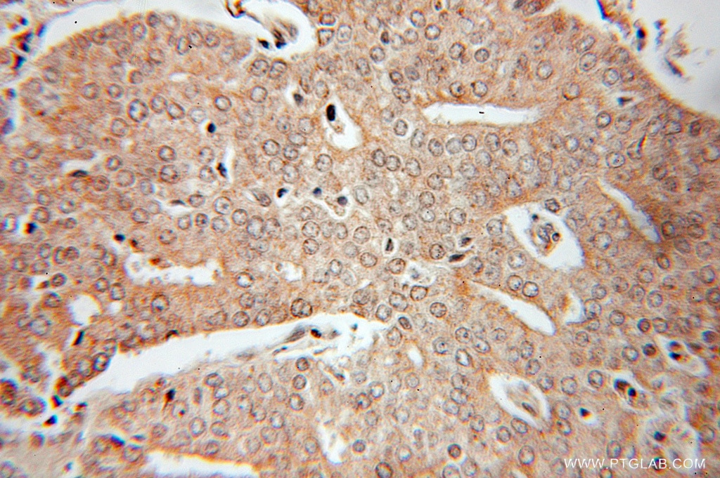 Immunohistochemistry of paraffin-embedded human prostate cancer using 10880-1-AP(GAMT Antibody) at Dilution 1:10 (under 25x lens) GAMT IHC Immunohistochemical 10880-1-AP GAMT Antibody PIG2; TP53I2