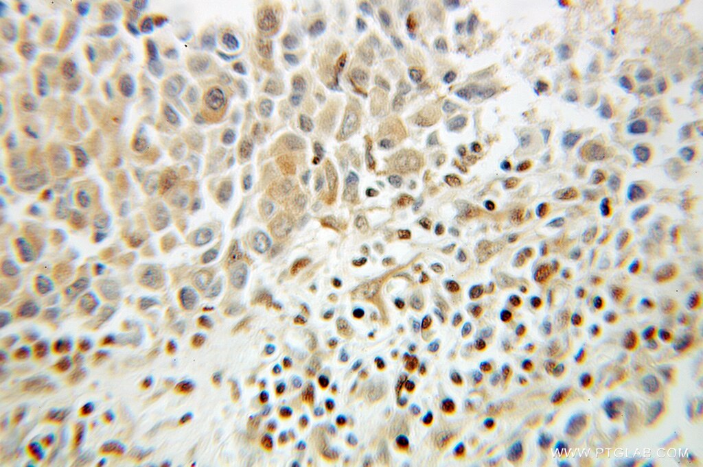 Immunohistochemistry of paraffin-embedded human breast cancer using GAPDH Antibody 10494-1-AP (under 10x lens) GAPDH IHC Immunohistochemistry 10494-1-AP GAPDH Antibody G3PD; GAPD; MGC88685