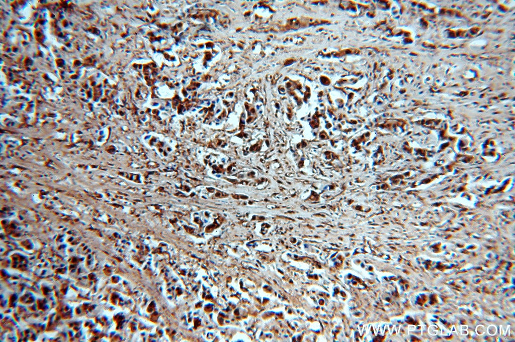 Immunohistochemistry of paraffin-embedded human breast cancer using GAPDH Antibody 10494-1-AP (under 10x lens) GAPDH IHC Immunohistochemistry 10494-1-AP GAPDH Antibody G3PD; GAPD; MGC88685