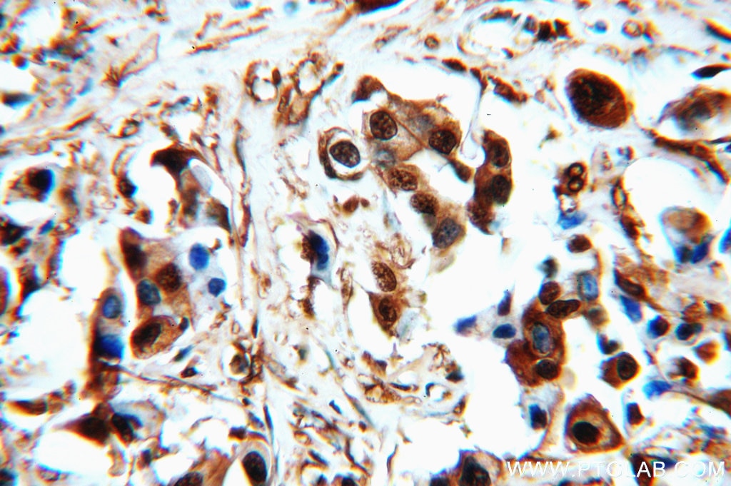 Immunohistochemistry of paraffin-embedded human breast cancer using GAPDH Antibody 10494-1-AP (under 40x lens) GAPDH IHC Immunohistochemistry 10494-1-AP GAPDH Antibody G3PD; GAPD; MGC88685