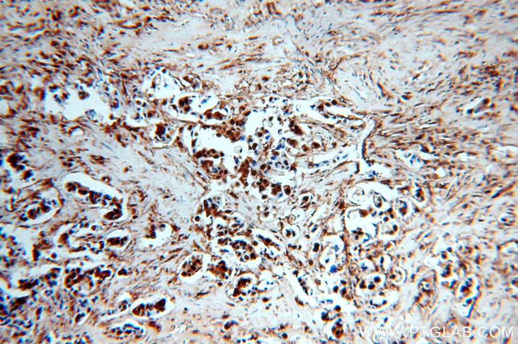 Immunohistochemistry of paraffin-embedded human breast cancer using GAPDH Antibody 10494-1-AP (under 10x lens) GAPDH IHC Immunohistochemistry 10494-1-AP GAPDH Antibody G3PD; GAPD; MGC88685