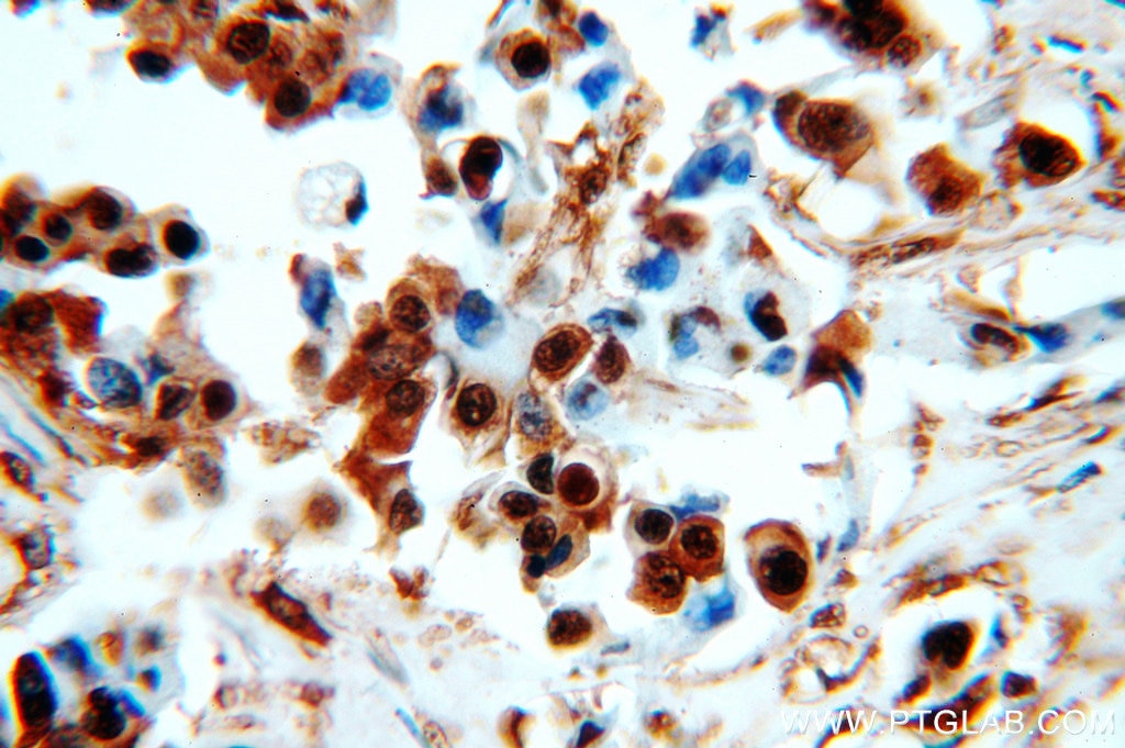 Immunohistochemistry of paraffin-embedded human breast cancer using GAPDH Antibody 10494-1-AP (under 40x lens) GAPDH IHC Immunohistochemistry 10494-1-AP GAPDH Antibody G3PD; GAPD; MGC88685