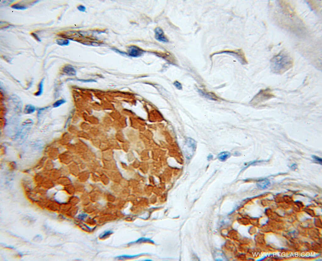 Immunohistochemistry of paraffin-embedded human colon cancer using 11293-1-AP(GFER Antibody) at Dilution 1:100 (under 10x lens) GFER IHC Immunohistochemical 11293-1-AP GFER Antibody ALR; ERV1; HERV1; HPO; HPO1; HPO2; HSS